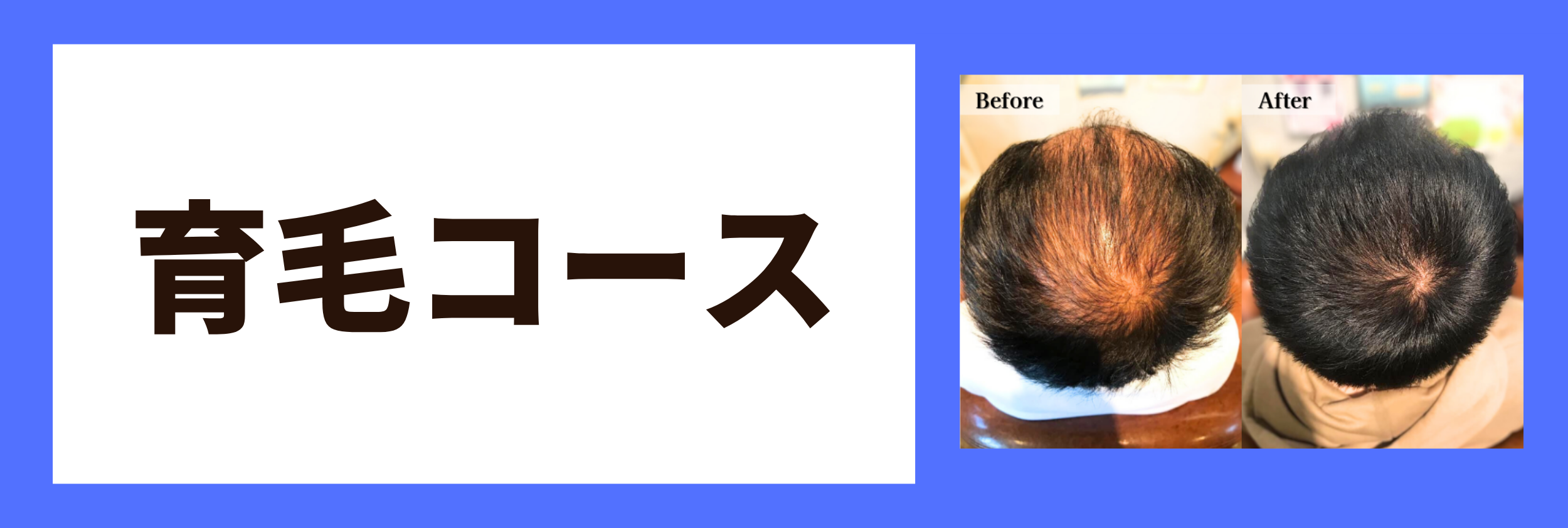 育毛コース