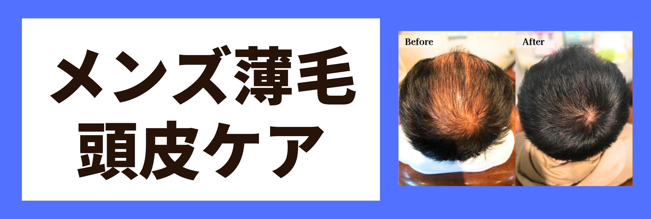 メンズ薄毛・頭皮ケア